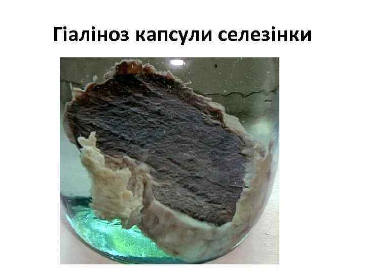 Гіаліноз капсули селезінки 