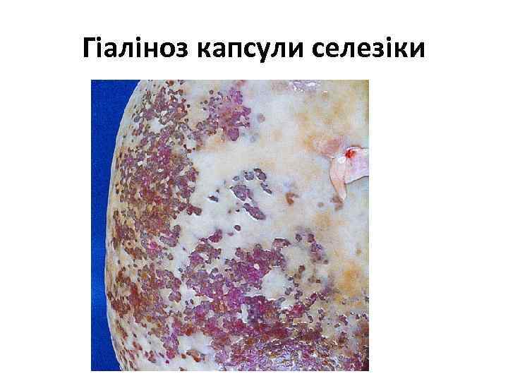 Гіаліноз капсули селезіки 