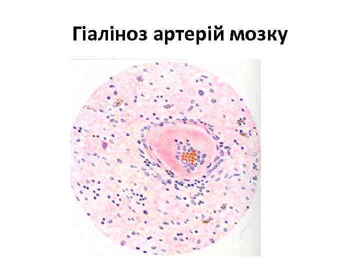 Гіаліноз артерій мозку 