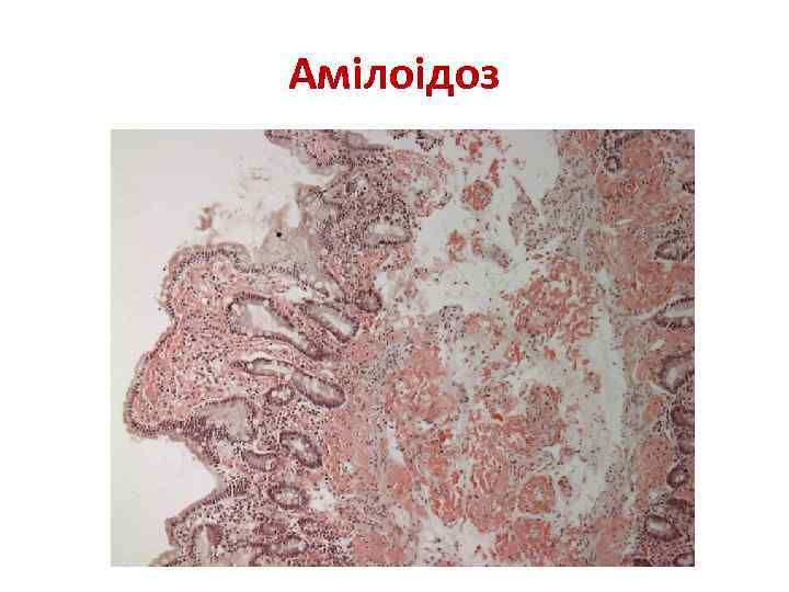 Амілоідоз 