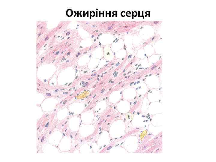 Ожиріння серця 