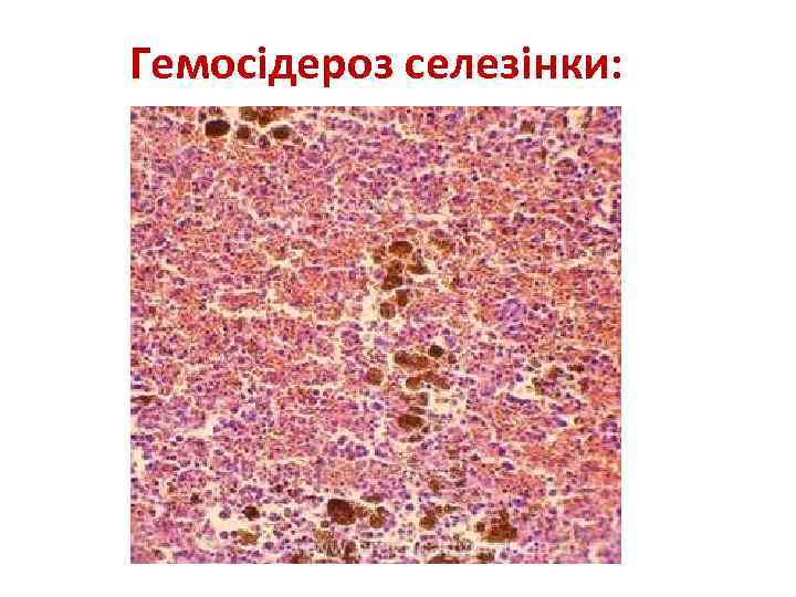 Гемосідероз селезінки: 