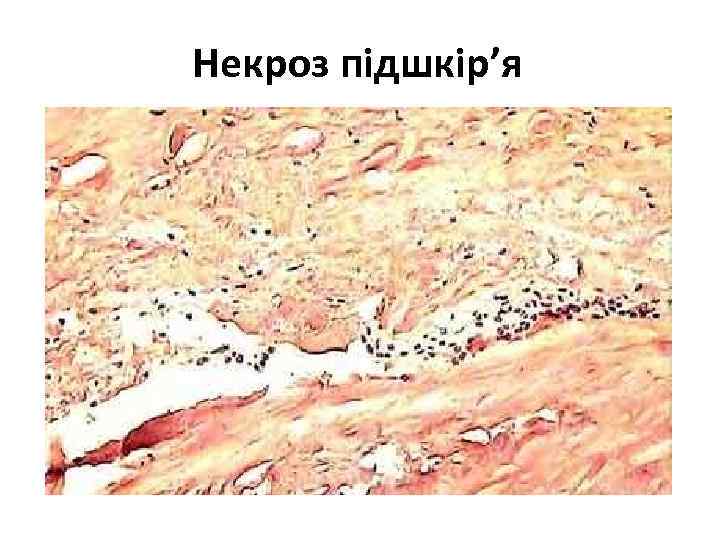 Некроз підшкір’я 