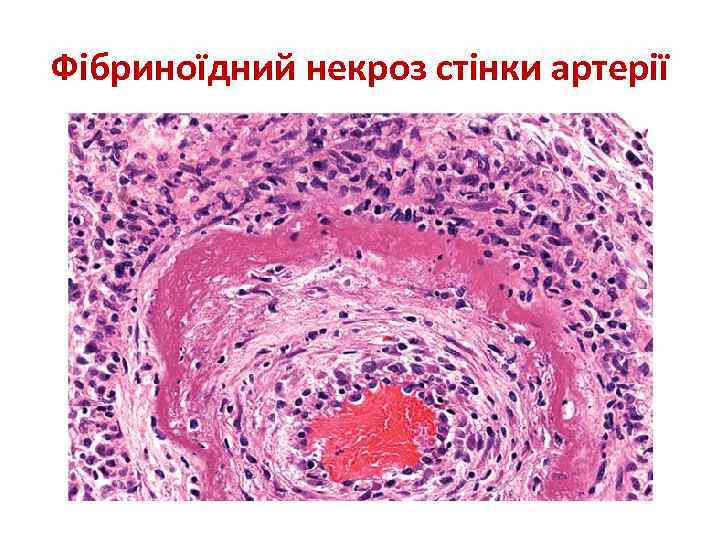 Фібриноїдний некроз стінки артерії 