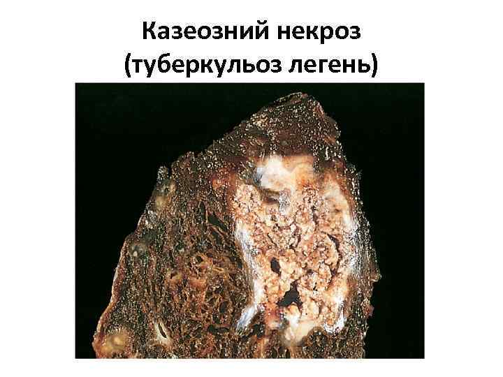 Казеозний некроз (туберкульоз легень) 
