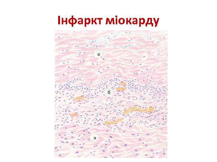 Інфаркт міокарду 