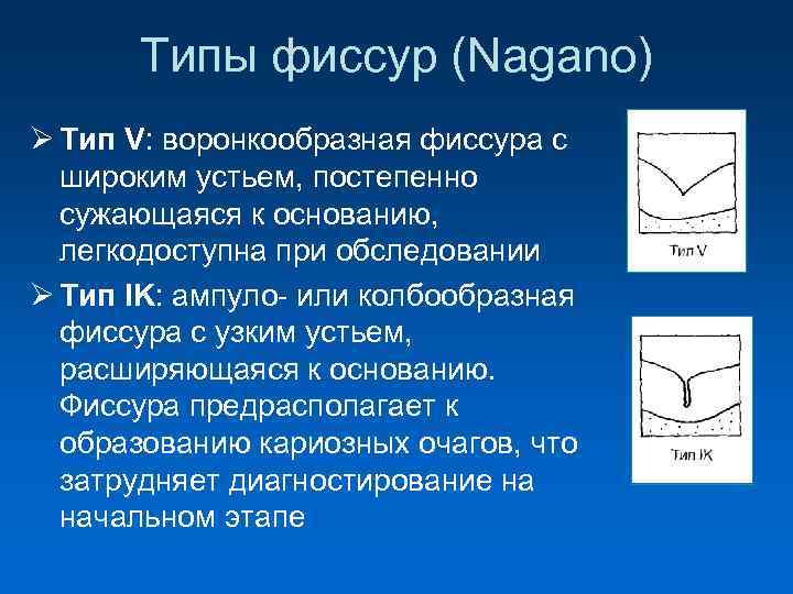  Типы фиссур (Nagano) Ø Тип V: воронкообразная фиссура с широким устьем, постепенно сужающаяся