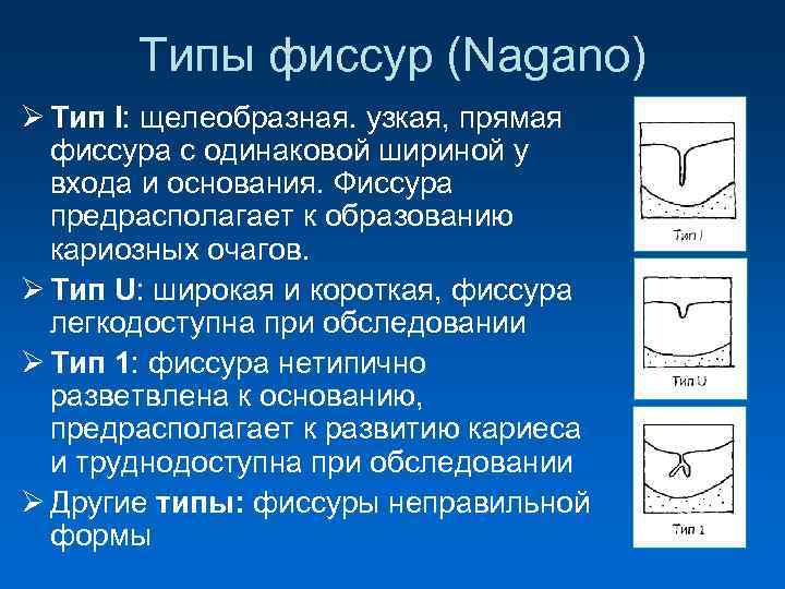  Типы фиссур (Nagano) Ø Тип I: щелеобразная. узкая, прямая фиссура с одинаковой шириной