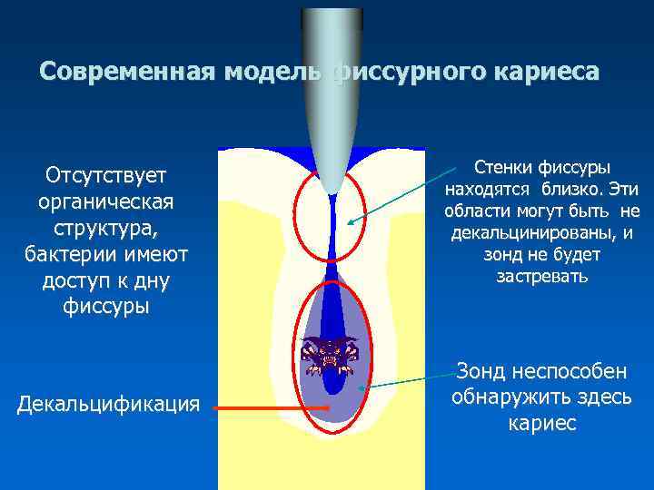  Современная модель фиссурного кариеса Отсутствует Стенки фиссуры находятся близко. Эти органическая области могут