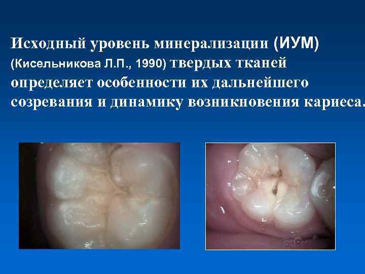 Исходный уровень минерализации (ИУМ) (Кисельникова Л. П. , 1990) твердых тканей определяет особенности их