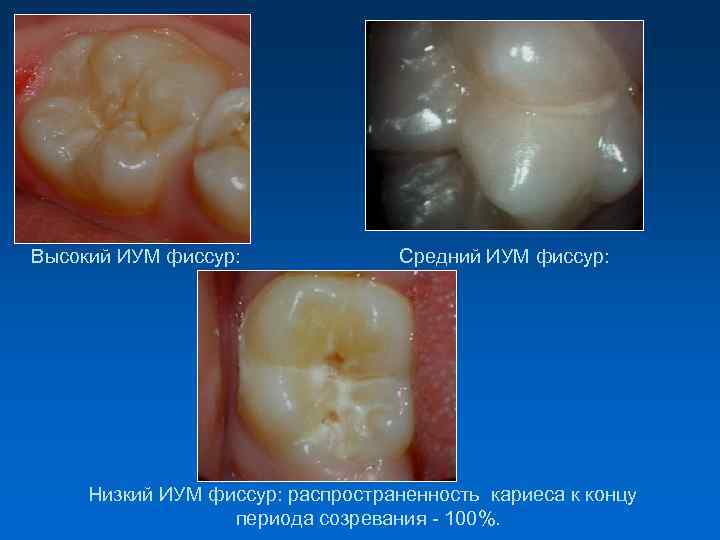 Высокий ИУМ фиссур: Средний ИУМ фиссур: Низкий ИУМ фиссур: распространенность кариеса к концу периода