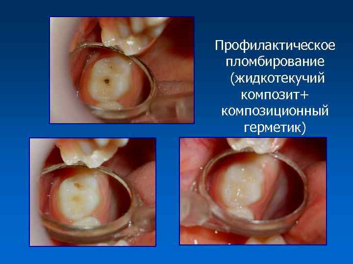 Профилактическое пломбирование (жидкотекучий композит+ композиционный герметик) 