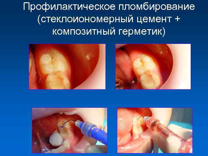 Профилактическое пломбирование (стеклоиономерный цемент + композитный герметик) 