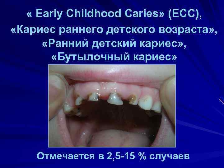  « Early Childhood Caries» (ECC), «Кариес раннего детского возраста» , «Ранний детский кариес»