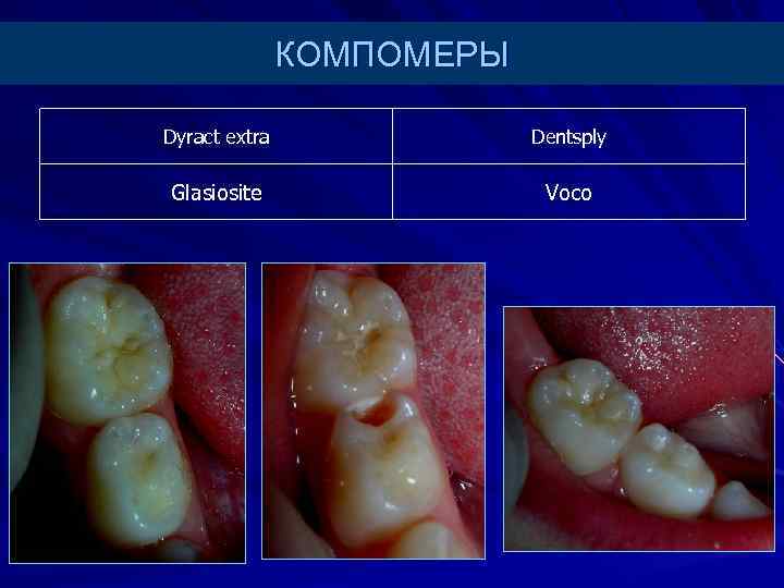 КОМПОМЕРЫ Dyract extra Dentsply Glasiosite Voco 