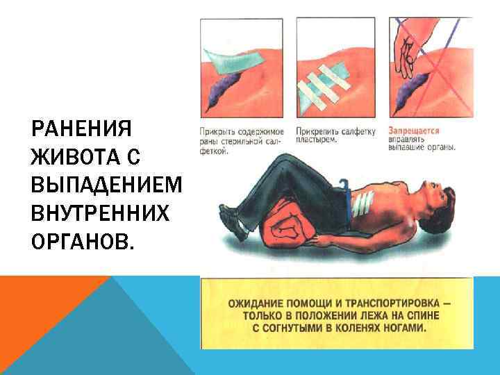 РАНЕНИЯ ЖИВОТА С ВЫПАДЕНИЕМ ВНУТРЕННИХ ОРГАНОВ. 