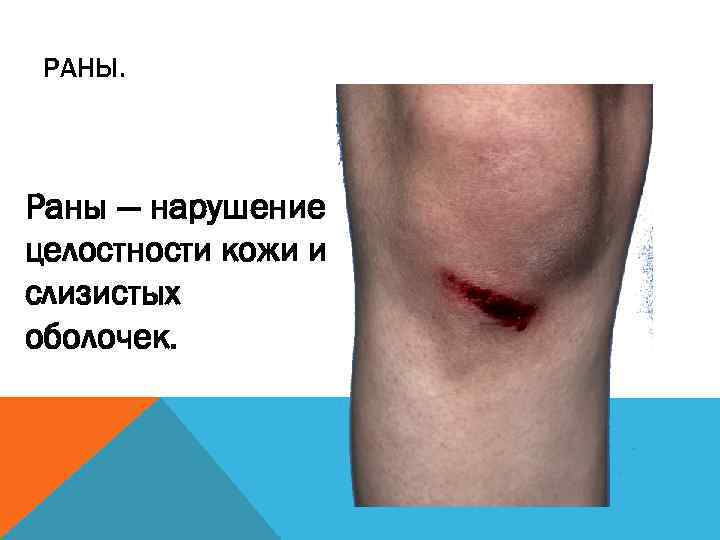 РАНЫ. Раны — нарушение целостности кожи и слизистых оболочек. 
