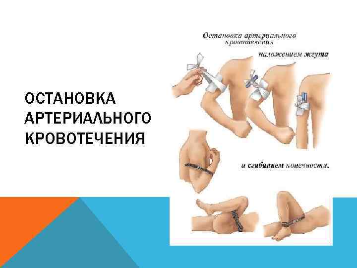 ОСТАНОВКА АРТЕРИАЛЬНОГО КРОВОТЕЧЕНИЯ 
