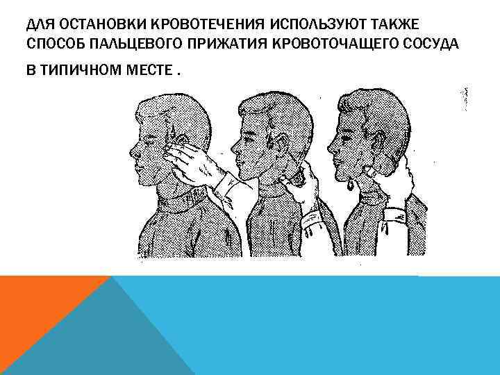 ДЛЯ ОСТАНОВКИ КРОВОТЕЧЕНИЯ ИСПОЛЬЗУЮТ ТАКЖЕ СПОСОБ ПАЛЬЦЕВОГО ПРИЖАТИЯ КРОВОТОЧАЩЕГО СОСУДА В ТИПИЧНОМ МЕСТЕ. 