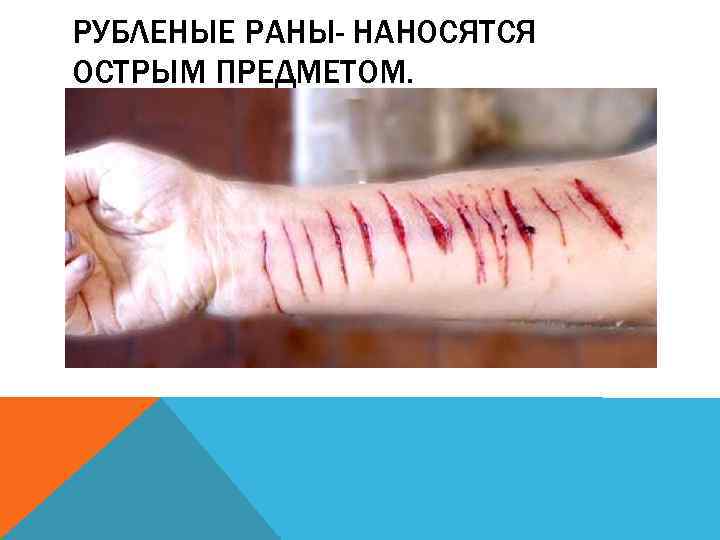 РУБЛЕНЫЕ РАНЫ- НАНОСЯТСЯ ОСТРЫМ ПРЕДМЕТОМ. 