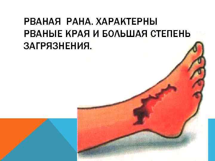 РВАНАЯ РАНА. ХАРАКТЕРНЫ РВАНЫЕ КРАЯ И БОЛЬШАЯ СТЕПЕНЬ ЗАГРЯЗНЕНИЯ. 