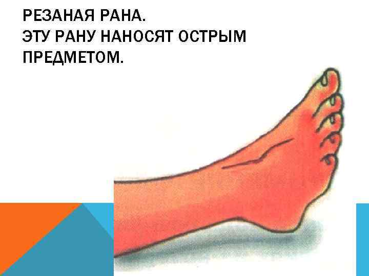 РЕЗАНАЯ РАНА. ЭТУ РАНУ НАНОСЯТ ОСТРЫМ ПРЕДМЕТОМ. 