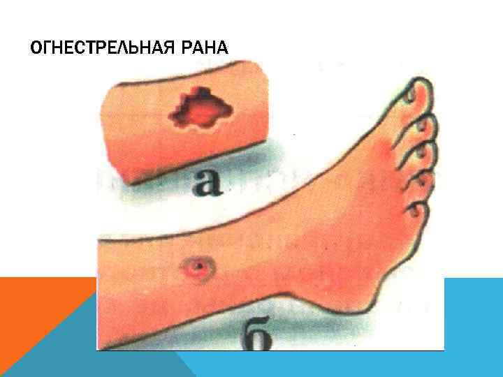 ОГНЕСТРЕЛЬНАЯ РАНА 