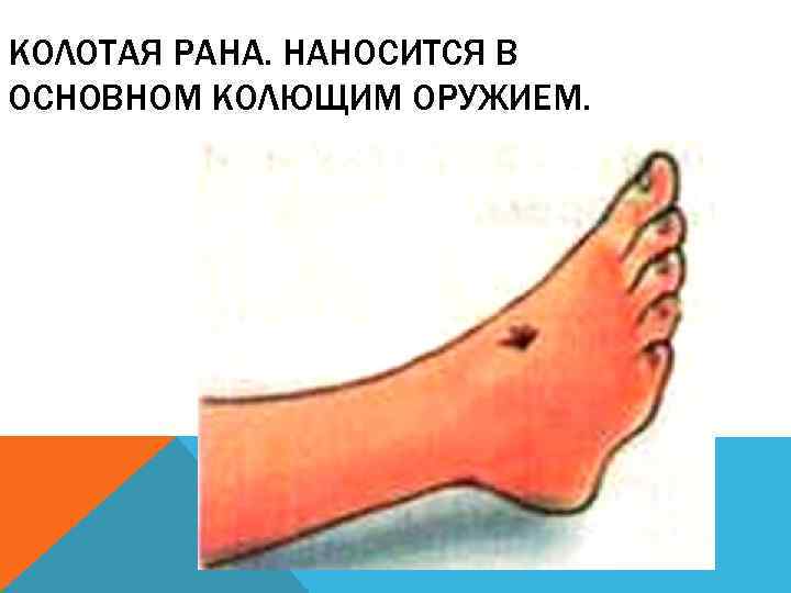 КОЛОТАЯ РАНА. НАНОСИТСЯ В ОСНОВНОМ КОЛЮЩИМ ОРУЖИЕМ. 