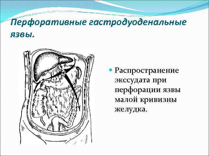 Перфоративные гастродуоденальные язвы. Распространение экссудата при перфорации язвы малой кривизны желудка. 