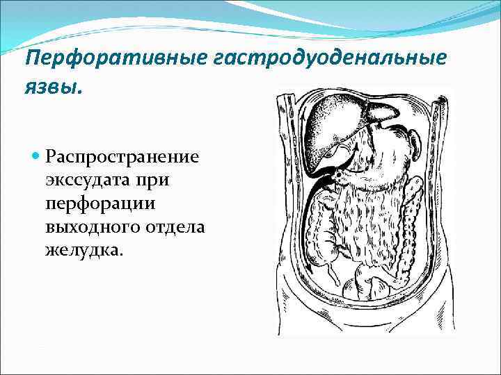 Перфоративные гастродуоденальные язвы. Распространение экссудата при перфорации выходного отдела желудка. 