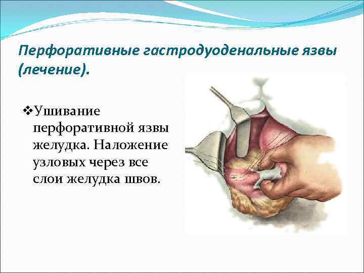 Перфоративные гастродуоденальные язвы (лечение). v. Ушивание перфоративной язвы желудка. Наложение узловых через все слои