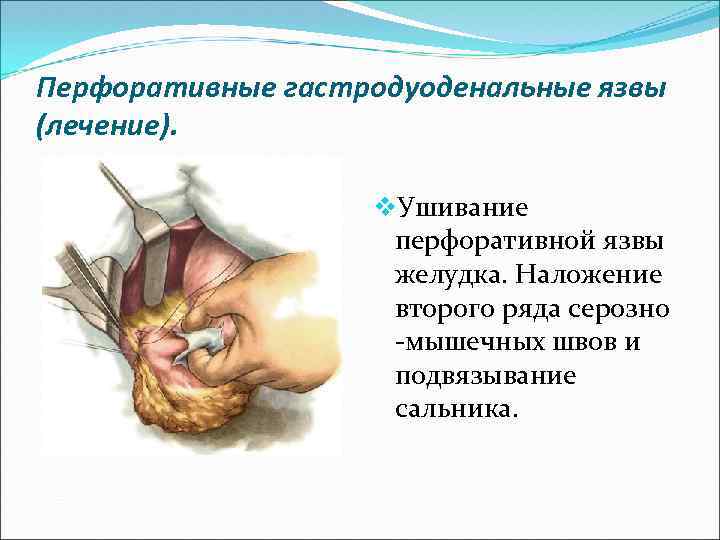 Перфоративные гастродуоденальные язвы (лечение). v. Ушивание перфоративной язвы желудка. Наложение второго ряда серозно -мышечных