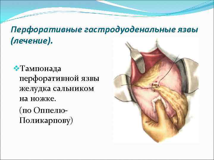 Перфоративная язва желудка карта вызова