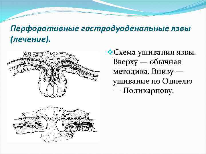 Перфоративные гастродуоденальные язвы (лечение). v. Схема ушивания язвы. Вверху — обычная методика. Внизу —
