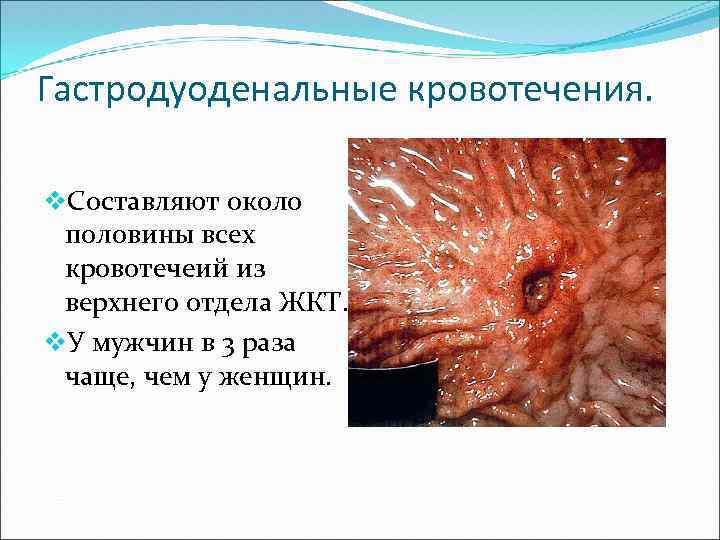 Гастродуоденальные кровотечения. v. Составляют около половины всех кровотечеий из верхнего отдела ЖКТ. v. У