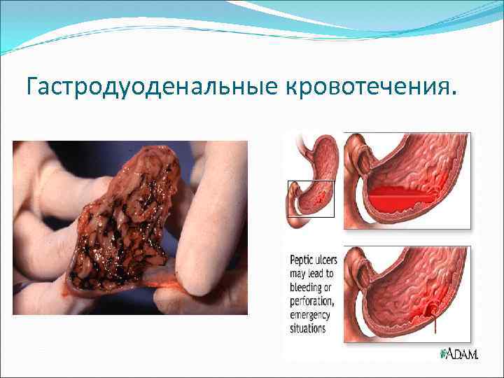 Гастродуоденальные кровотечения. 