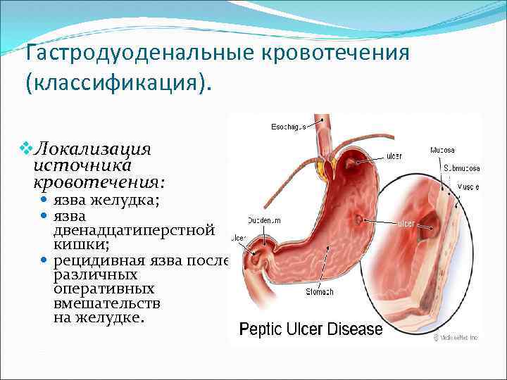 Перфоративная язва желудка карта вызова