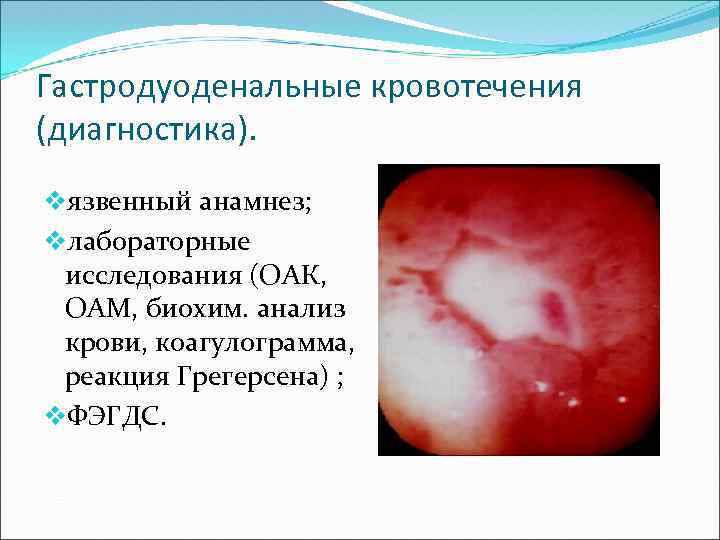 Гастродуоденальные кровотечения (диагностика). vязвенный анамнез; vлабораторные исследования (ОАК, ОАМ, биохим. анализ крови, коагулограмма, реакция