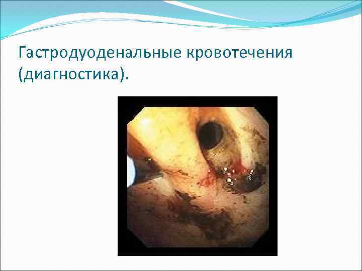 Гастродуоденальные кровотечения (диагностика). 