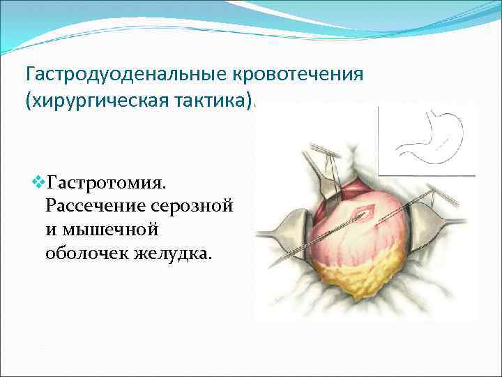 Диагностика гастродуоденальных кровотечений презентация