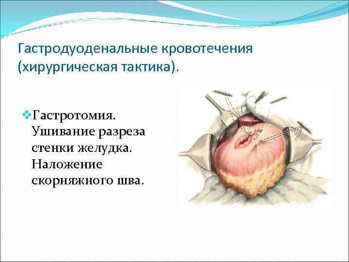 Гастродуоденальные кровотечения (хирургическая тактика). v. Гастротомия. Ушивание разреза стенки желудка. Наложение скорняжного шва. 