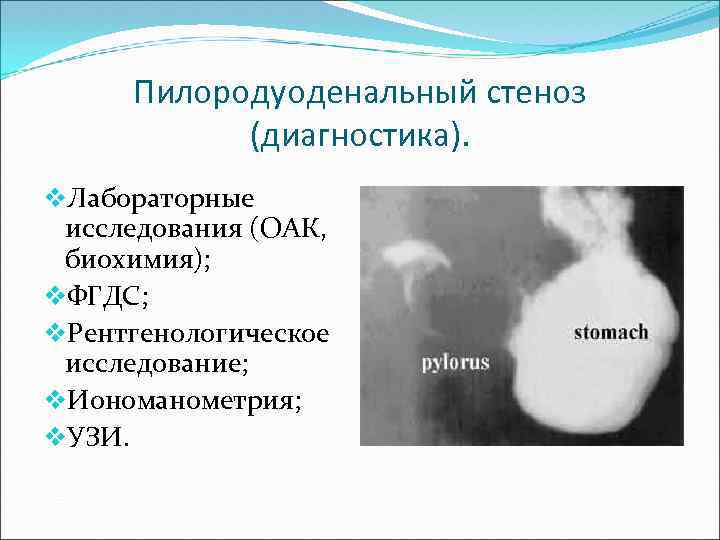 Пилородуоденальный стеноз презентация