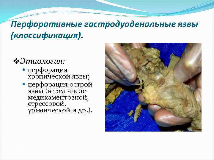 Перфоративные гастродуоденальные язвы (классификация). v. Этиология: перфорация хронической язвы; перфорация острой язвы (в том