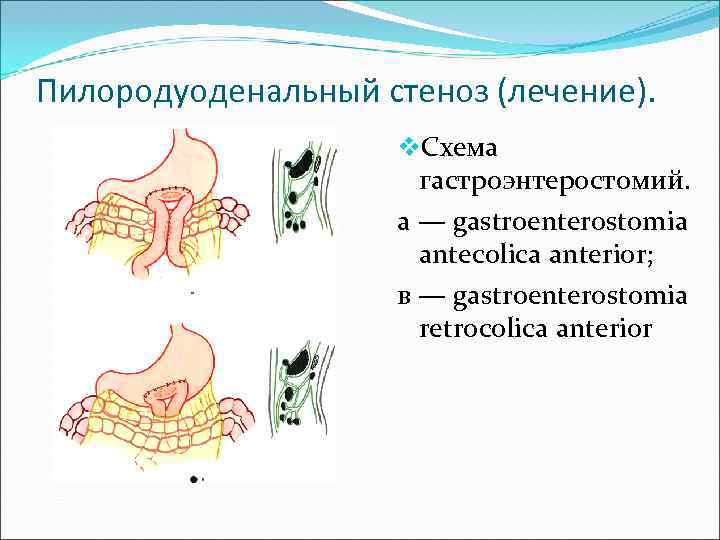 Пилородуоденальный стеноз презентация