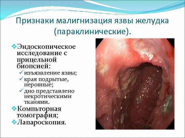 Презентация осложнения язвенной болезни