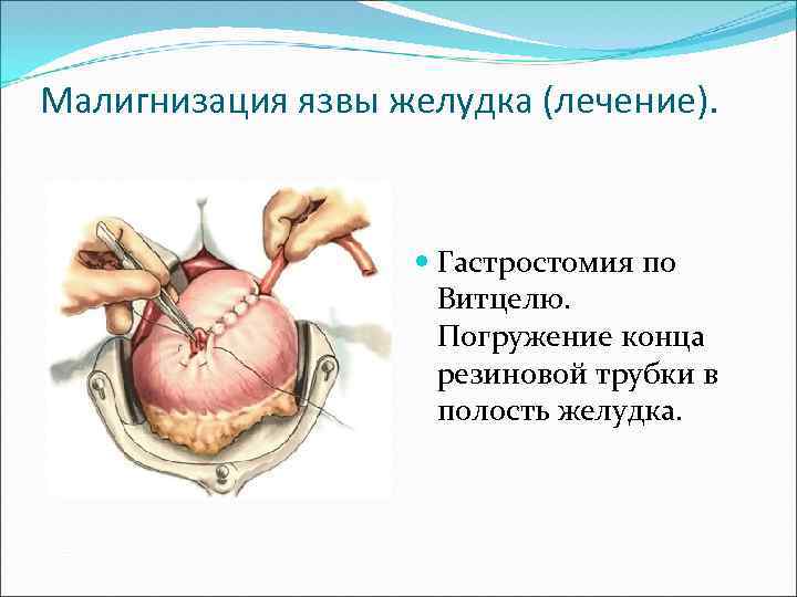 Презентация осложнения язвенной болезни