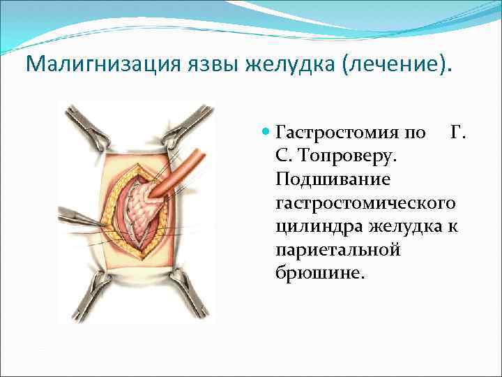 Малигнизация язвы желудка (лечение). Гастростомия по Г. С. Топроверу. Подшивание гастростомического цилиндра желудка к