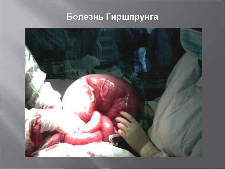 Болезнь Гиршпрунга 