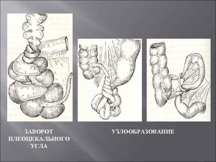 ЗАВОРОТ ИЛЕОЦЕКАЛЬНОГО УГЛА УЗЛООБРАЗОВАНИЕ 