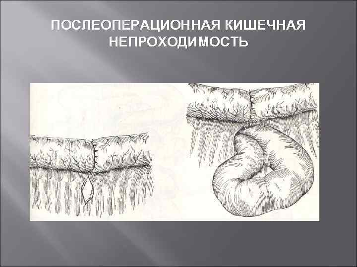 ПОСЛЕОПЕРАЦИОННАЯ КИШЕЧНАЯ НЕПРОХОДИМОСТЬ 